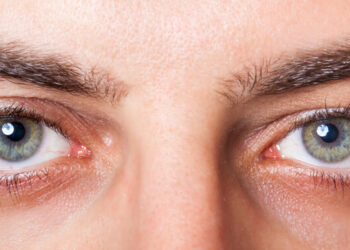 Keratitis: Gejala, Penyebab, Pengobatan, dan Pencegahan