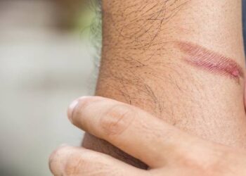 Luka Bakar: Gejala, Penyebab, dan Pengobatan