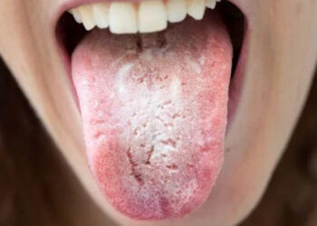Candidiasis Mulut: Gejala, Penyebab, dan Pengobatan
