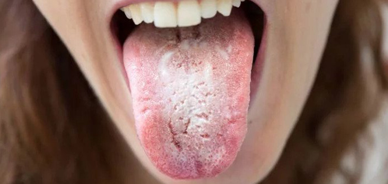 Alasan Mengapa Mulut Bau Salah Satunya Akibat Penyakit Ini 