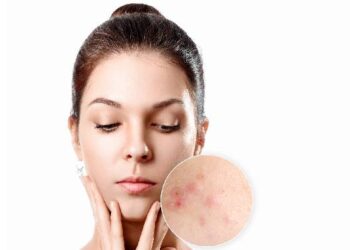 Penyebab dan Cara Mengatasi Jerawat Meradang