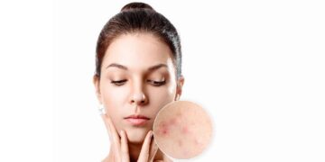 Penyebab dan Cara Mengatasi Jerawat Meradang