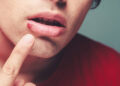 Herpes: Gejala, Penyebab, dan Pengobatan