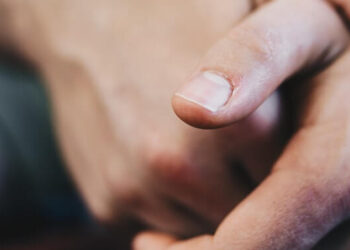 Kusta: Gejala, Penyebab, dan Pengobatan