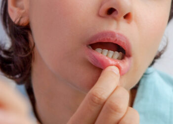 Sariawan: Gejala, Penyebab, dan Pengobatan