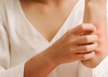 obat biduran yang ampuh