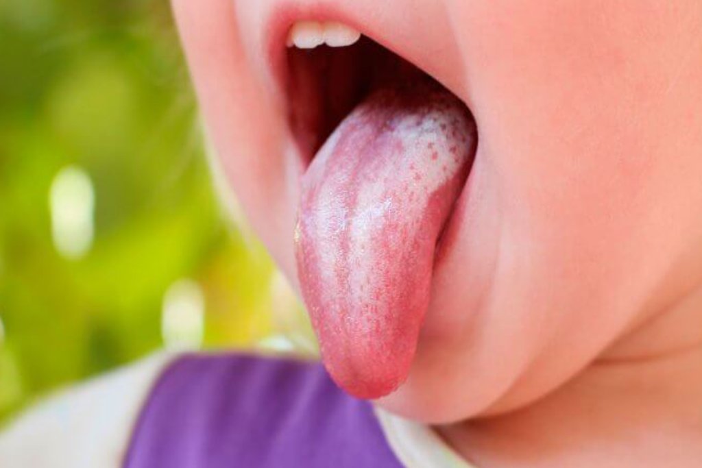 cara mengobati sariawan di lidah