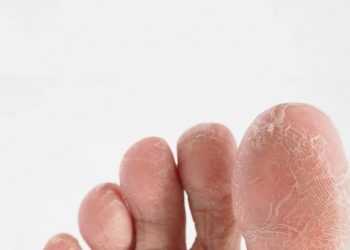 obat kapalan di apotek