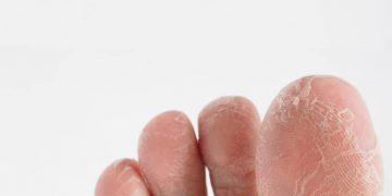 obat kapalan di apotek