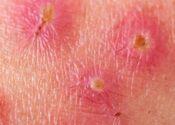 salep untuk impetigo