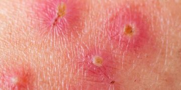 salep untuk impetigo