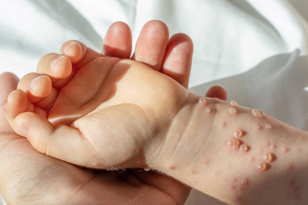Gambar obat cacar air untuk anak