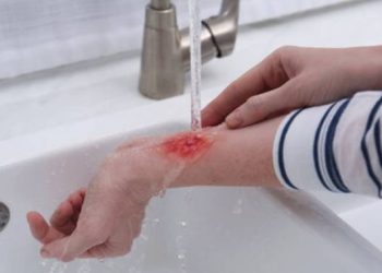 salep untuk luka tersiram air panas