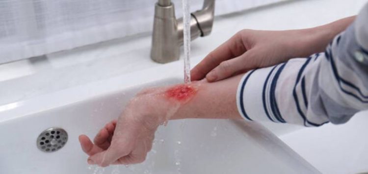 8 Jenis Salep untuk Mengatasi Luka Tersiram Air Panas