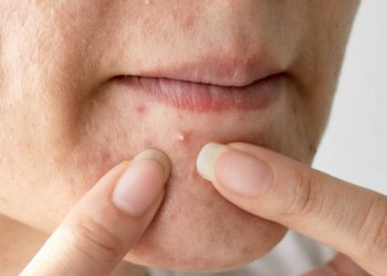 gambar produk cetaphil untuk kulit berjerawat