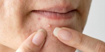 gambar produk cetaphil untuk kulit berjerawat