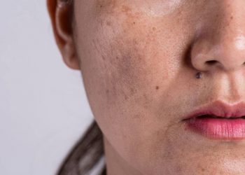 Gambar Olay untuk menghilangkan plak hitam