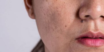 Gambar Olay untuk menghilangkan plak hitam