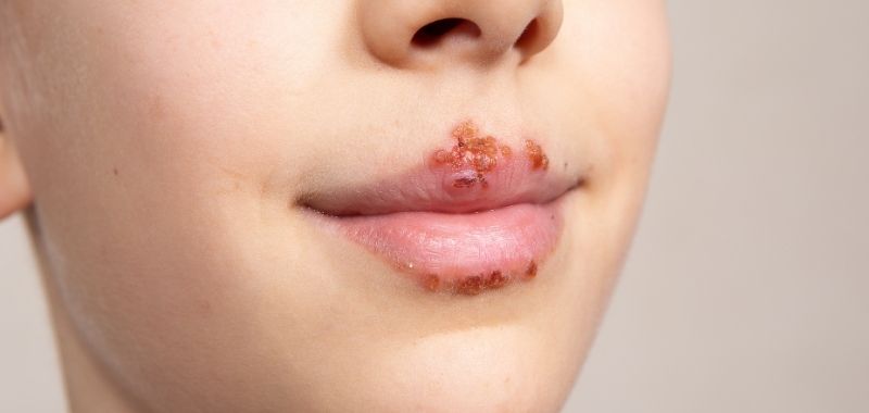 Obat Herpes di Apotek yang Umum Diresepkan Dokter