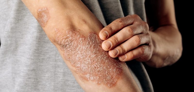 gambar psoriasis