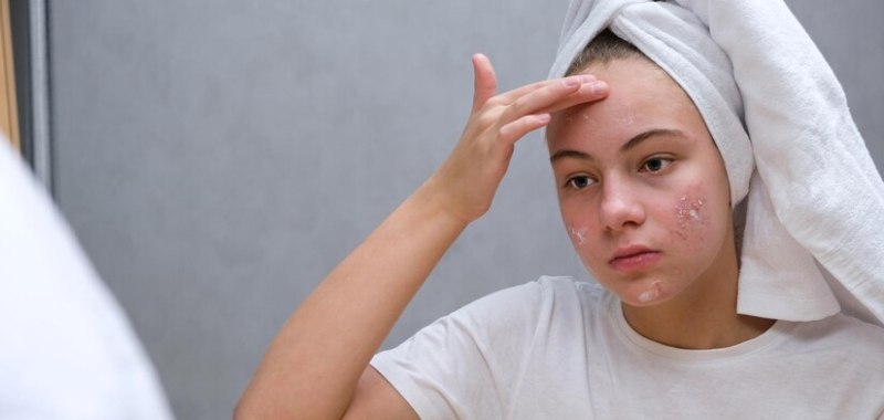 gambar skincare untuk menghilangkan bekas jerawat