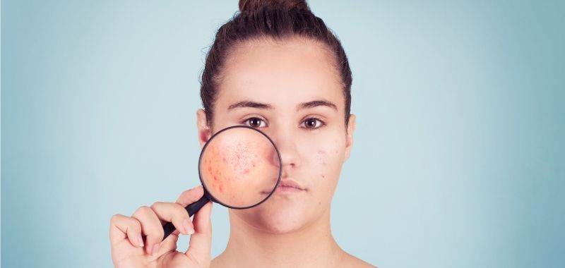 Kulit Acne Prone, Kenali Penyebab & Cara Merawatnya