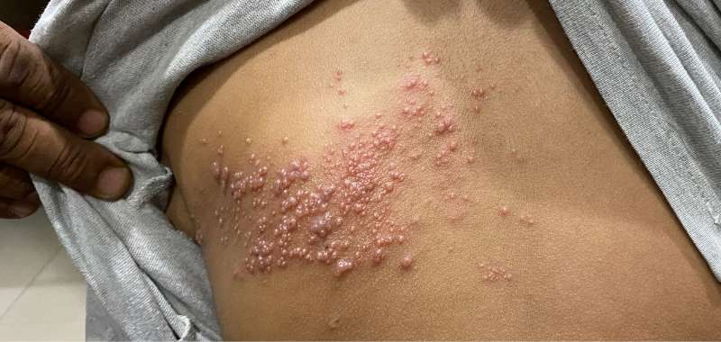 Obat Cacar Api yang Ampuh