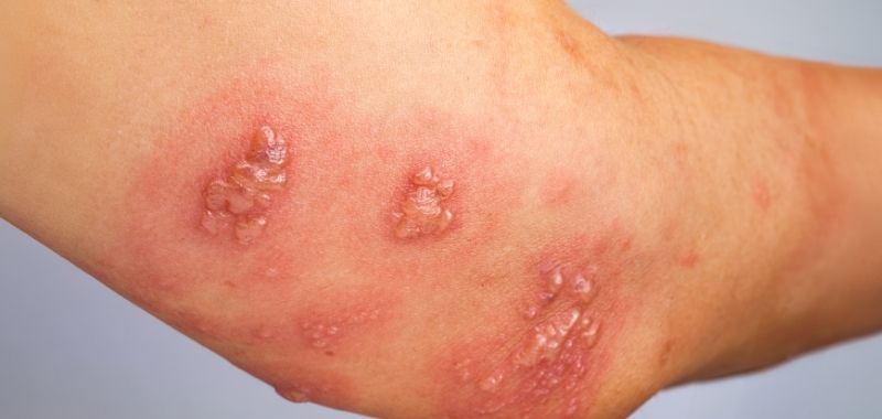Obat Herpes Zoster