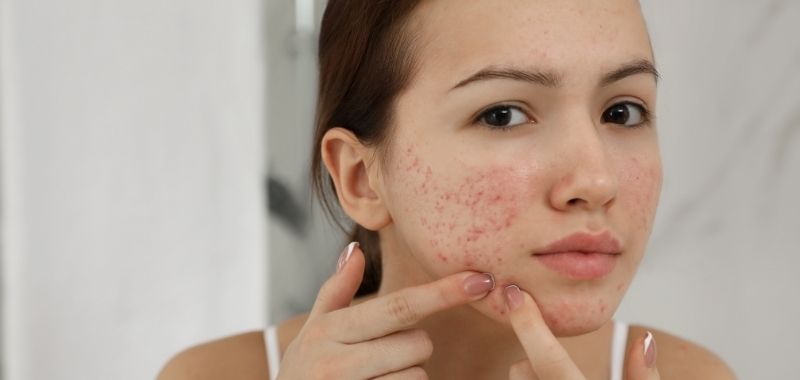 Obat Jerawat di Apotek