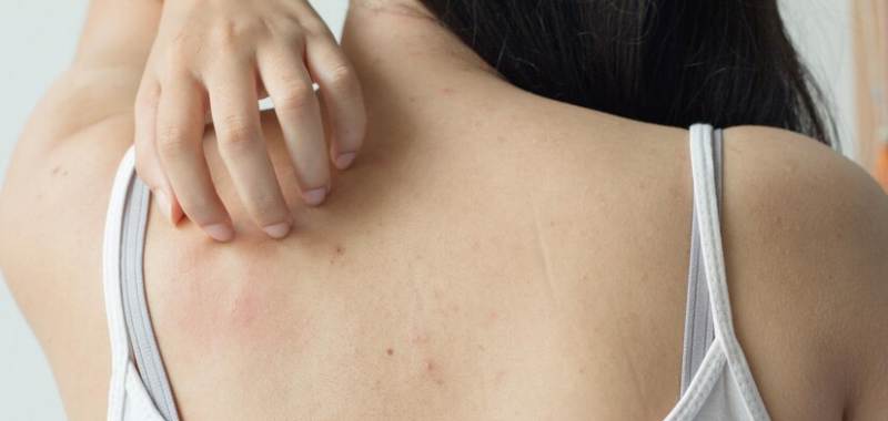 gambar obat jerawat punggung di apotek