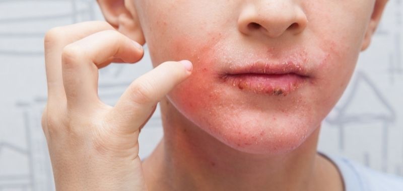 Produk Perawatan Eksim di Bibir yang Paling Efektif di Apotek